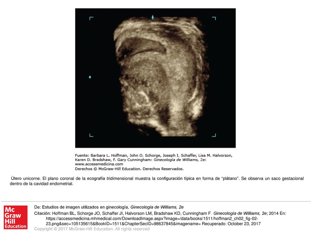 Útero unicorne. El plano coronal de la ecografía tridimensional muestra la configuración típica en forma de plátano . Se observa un saco gestacional dentro de la cavidad endometrial.