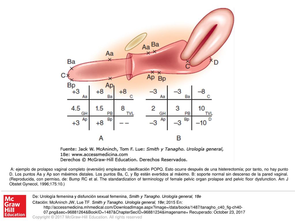 A: ejemplo de prolapso vaginal completo (eversión) empleando clasificación POPQ. Esto ocurre después de una histerectomía; por tanto, no hay punto D. Los puntos Aa y Ap son máximos distales. Los puntos Ba, C, y Bp están evertidos al máximo. B: soporte normal sin descenso de la pared vaginal. (Reproducida, con permiso, de: Bump RC et al. The standardization of terminology of female pelvic organ prolapse and pelvic floor dysfunction. Am J Obstet Gynecol, 1996;175:10.)