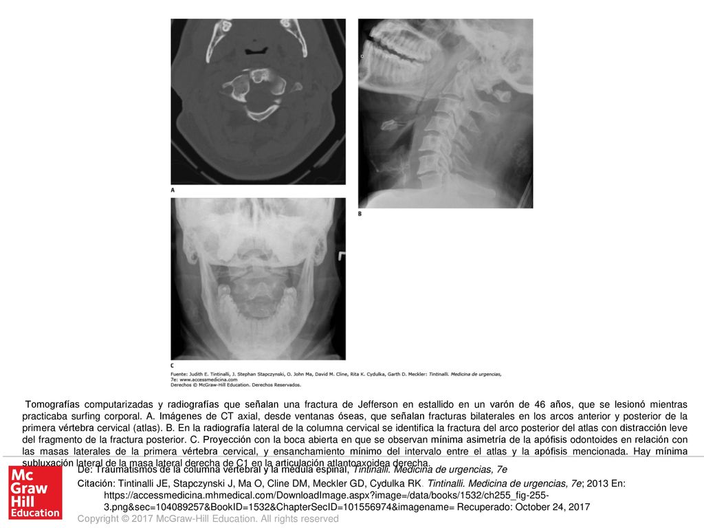 Tomografías computarizadas y radiografías que señalan una fractura de Jefferson en estallido en un varón de 46 años, que se lesionó mientras practicaba surfing corporal. A. Imágenes de CT axial, desde ventanas óseas, que señalan fracturas bilaterales en los arcos anterior y posterior de la primera vértebra cervical (atlas). B. En la radiografía lateral de la columna cervical se identifica la fractura del arco posterior del atlas con distracción leve del fragmento de la fractura posterior. C. Proyección con la boca abierta en que se observan mínima asimetría de la apófisis odontoides en relación con las masas laterales de la primera vértebra cervical, y ensanchamiento mínimo del intervalo entre el atlas y la apófisis mencionada. Hay mínima subluxación lateral de la masa lateral derecha de C1 en la articulación atlantoaxoidea derecha.