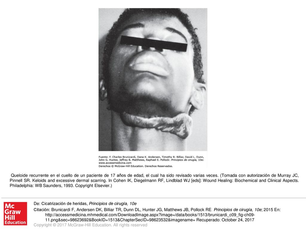 Queloide recurrente en el cuello de un paciente de 17 años de edad, el cual ha sido revisado varias veces. (Tomada con autorización de Murray JC, Pinnell SR. Keloids and excessive dermal scarring. In Cohen IK, Diegelmann RF, Lindblad WJ [eds]: Wound Healing: Biochemical and Clinical Aspects. Philadelphia: WB Saunders, Copyright Elsevier.)