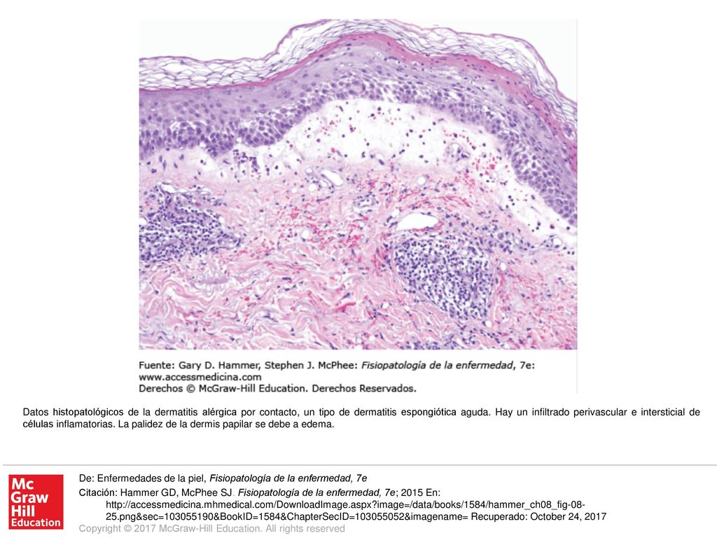 Datos histopatológicos de la dermatitis alérgica por contacto, un tipo de dermatitis espongiótica aguda. Hay un infiltrado perivascular e intersticial de células inflamatorias. La palidez de la dermis papilar se debe a edema.