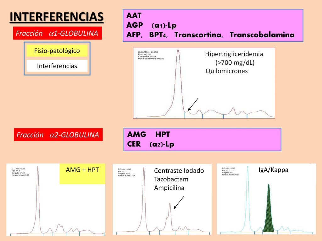 INTERFERENCIAS AAT. AGP (a1)-Lp AFP, BPT4, Transcortina, Transcobalamina. Fracción a1-GLOBULINA.
