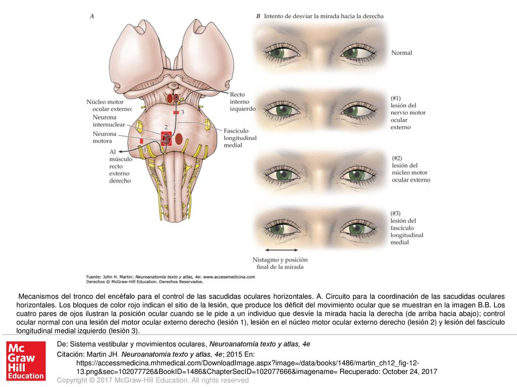 Mecanismos del tronco del encéfalo para el control de las sacudidas oculares horizontales. A. Circuito para la coordinación de las sacudidas oculares horizontales. Los bloques de color rojo indican el sitio de la lesión, que produce los déficit del movimiento ocular que se muestran en la imagen B.B. Los cuatro pares de ojos ilustran la posición ocular cuando se le pide a un individuo que desvíe la mirada hacia la derecha (de arriba hacia abajo); control ocular normal con una lesión del motor ocular externo derecho (lesión 1), lesión en el núcleo motor ocular externo derecho (lesión 2) y lesión del fascículo longitudinal medial izquierdo (lesión 3).