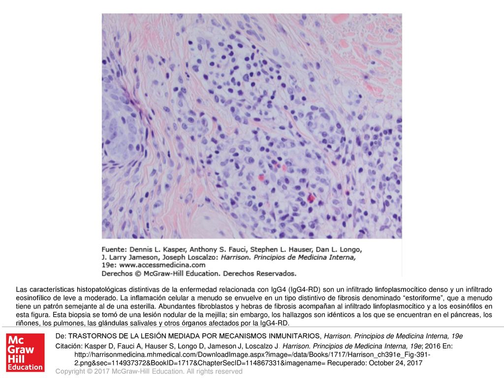 Las características histopatológicas distintivas de la enfermedad relacionada con IgG4 (IgG4-RD) son un infiltrado linfoplasmocítico denso y un infiltrado eosinofílico de leve a moderado. La inflamación celular a menudo se envuelve en un tipo distintivo de fibrosis denominado estoriforme , que a menudo tiene un patrón semejante al de una esterilla. Abundantes fibroblastos y hebras de fibrosis acompañan al infiltrado linfoplasmocítico y a los eosinófilos en esta figura. Esta biopsia se tomó de una lesión nodular de la mejilla; sin embargo, los hallazgos son idénticos a los que se encuentran en el páncreas, los riñones, los pulmones, las glándulas salivales y otros órganos afectados por la IgG4-RD.