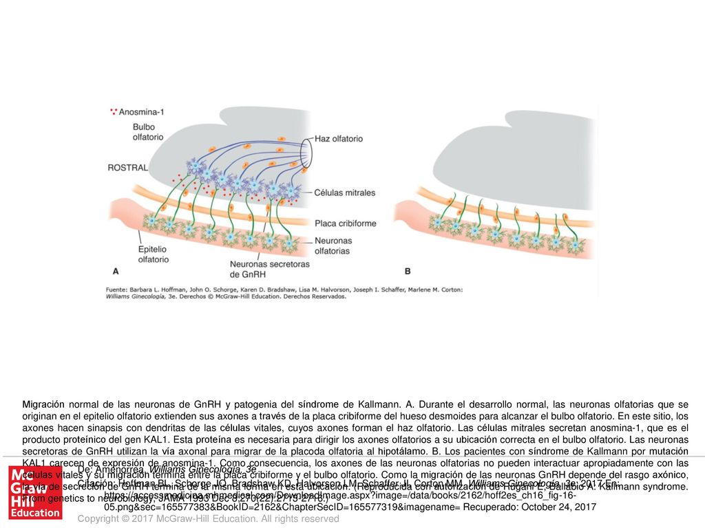 Migración normal de las neuronas de GnRH y patogenia del síndrome de Kallmann. A. Durante el desarrollo normal, las neuronas olfatorias que se originan en el epitelio olfatorio extienden sus axones a través de la placa cribiforme del hueso desmoides para alcanzar el bulbo olfatorio. En este sitio, los axones hacen sinapsis con dendritas de las células vitales, cuyos axones forman el haz olfatorio. Las células mitrales secretan anosmina-1, que es el producto proteínico del gen KAL1. Esta proteína es necesaria para dirigir los axones olfatorios a su ubicación correcta en el bulbo olfatorio. Las neuronas secretoras de GnRH utilizan la vía axonal para migrar de la placoda olfatoria al hipotálamo. B. Los pacientes con síndrome de Kallmann por mutación KAL1 carecen de expresión de anosmina-1. Como consecuencia, los axones de las neuronas olfatorias no pueden interactuar apropiadamente con las células vitales y su migración termina entre la placa cribiforme y el bulbo olfatorio. Como la migración de las neuronas GnRH depende del rasgo axónico, la vía de secreción de GnRH termina de la misma forma en esta ubicación. (Reproducida con autorización de Rugarli E, Ballabio A: Kallmann syndrome. From genetics to neurobiology, JAMA 1993 Dec 8;270(22): )