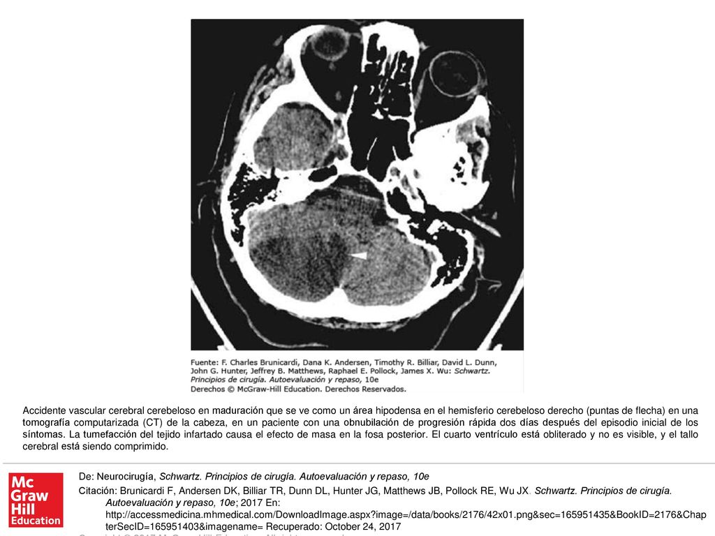 Accidente vascular cerebral cerebeloso en maduración que se ve como un área hipodensa en el hemisferio cerebeloso derecho (puntas de flecha) en una tomografía computarizada (CT) de la cabeza, en un paciente con una obnubilación de progresión rápida dos días después del episodio inicial de los síntomas. La tumefacción del tejido infartado causa el efecto de masa en la fosa posterior. El cuarto ventrículo está obliterado y no es visible, y el tallo cerebral está siendo comprimido.