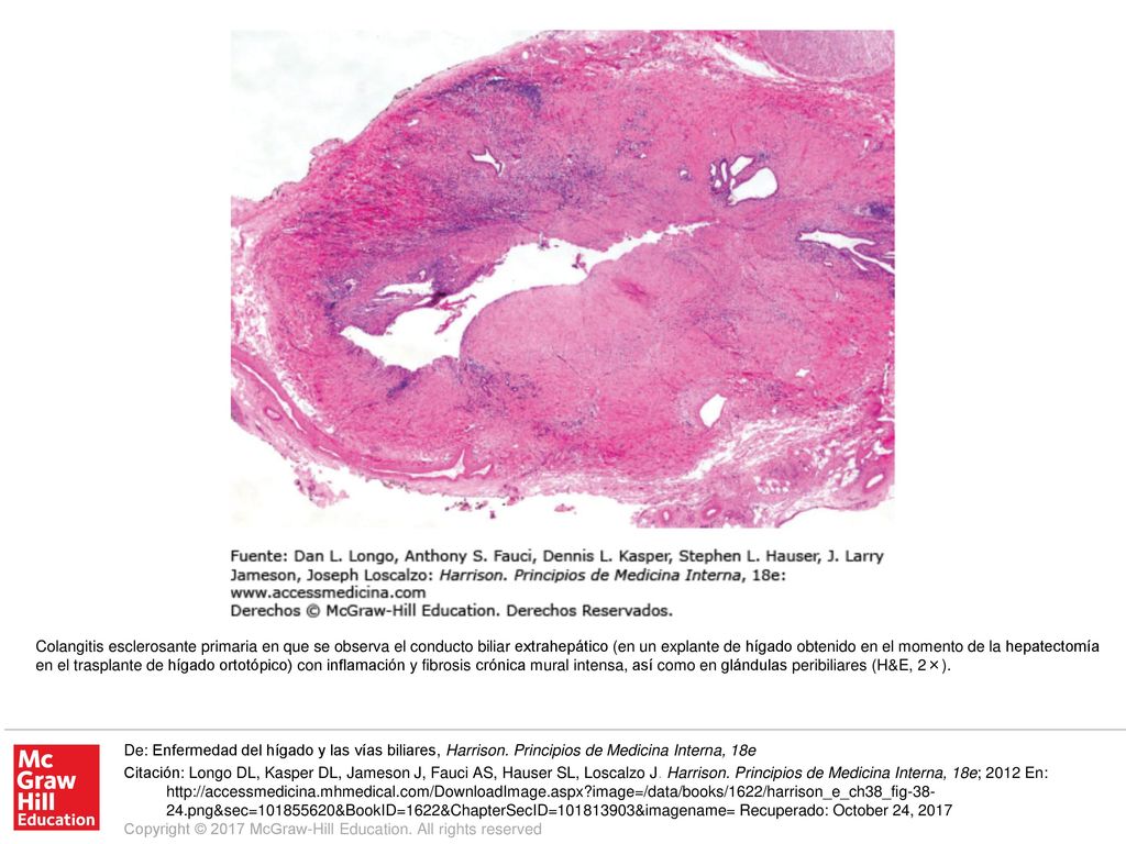 Colangitis esclerosante primaria en que se observa el conducto biliar extrahepático (en un explante de hígado obtenido en el momento de la hepatectomía en el trasplante de hígado ortotópico) con inflamación y fibrosis crónica mural intensa, así como en glándulas peribiliares (H&E, 2×).