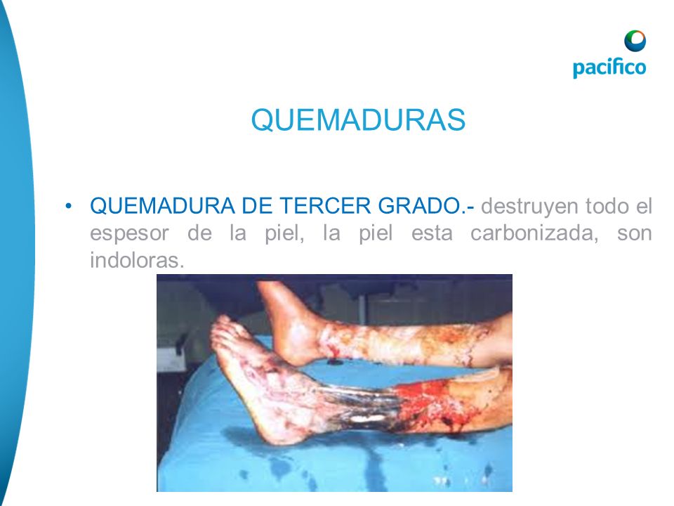 QUEMADURAS QUEMADURA DE TERCER GRADO.- destruyen todo el espesor de la piel, la piel esta carbonizada, son indoloras.