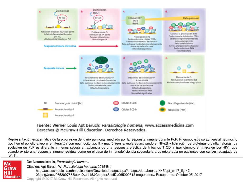 Representación esquemática de la progresión del daño pulmonar mediado por la respuesta inmune durante PcP. Pneumocystis se adhiere al neumocito tipo I en el epitelio alveolar e interactúa con neumocito tipo II y macrófagos alveolares activando el NF-κB y liberación de proteínas proinflamatorias. La evolución de PcP es diferente y menos severa en ausencia de una respuesta efectiva de linfocitos T CD4+ (por ejemplo en infección por HIV), que cuando existe una respuesta inmune residual como en el caso de inmunodeficiencia secundaria a quimioterapia en pacientes con cáncer (adaptado de ref. 3).