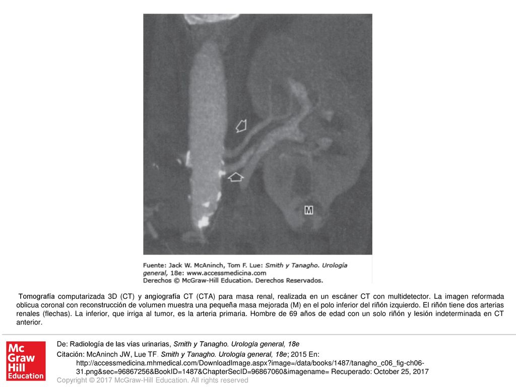 Tomografía computarizada 3D (CT) y angiografía CT (CTA) para masa renal, realizada en un escáner CT con multidetector. La imagen reformada oblicua coronal con reconstrucción de volumen muestra una pequeña masa mejorada (M) en el polo inferior del riñón izquierdo. El riñón tiene dos arterias renales (flechas). La inferior, que irriga al tumor, es la arteria primaria. Hombre de 69 años de edad con un solo riñón y lesión indeterminada en CT anterior.