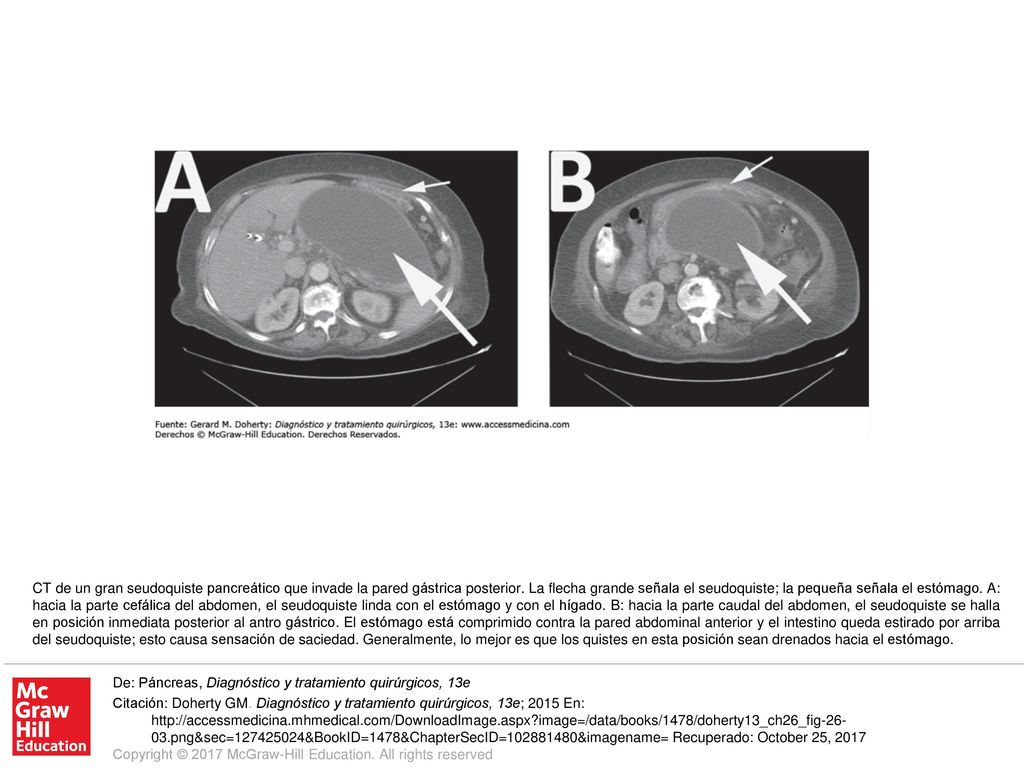 CT de un gran seudoquiste pancreático que invade la pared gástrica posterior. La flecha grande señala el seudoquiste; la pequeña señala el estómago. A: hacia la parte cefálica del abdomen, el seudoquiste linda con el estómago y con el hígado. B: hacia la parte caudal del abdomen, el seudoquiste se halla en posición inmediata posterior al antro gástrico. El estómago está comprimido contra la pared abdominal anterior y el intestino queda estirado por arriba del seudoquiste; esto causa sensación de saciedad. Generalmente, lo mejor es que los quistes en esta posición sean drenados hacia el estómago.