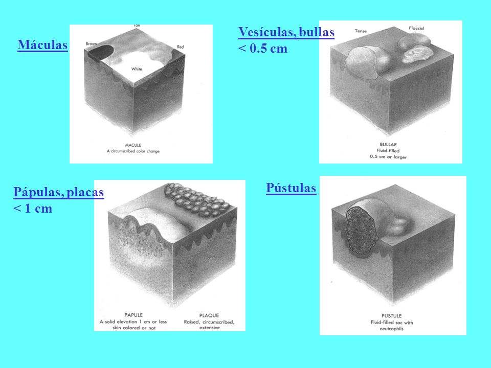 Vesículas, bullas < 0.5 cm Máculas Pústulas Pápulas, placas < 1 cm