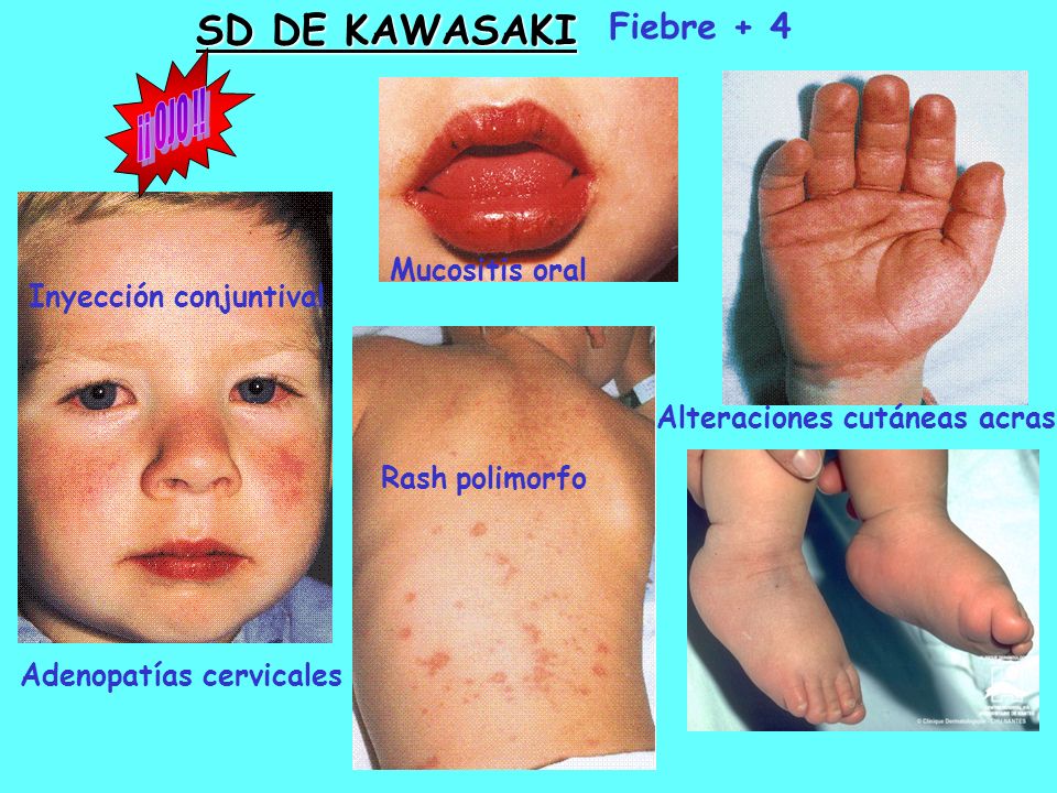 ¡¡ OJO !! SD DE KAWASAKI Fiebre + 4 Mucositis oral