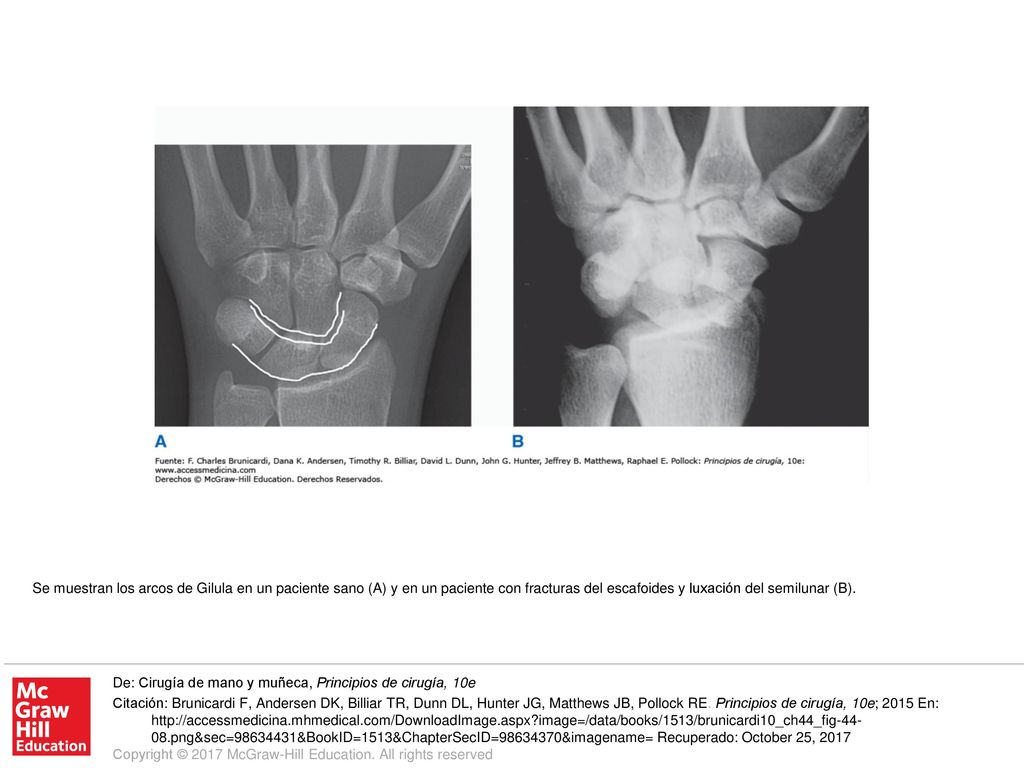 Se muestran los arcos de Gilula en un paciente sano (A) y en un paciente con fracturas del escafoides y luxación del semilunar (B).