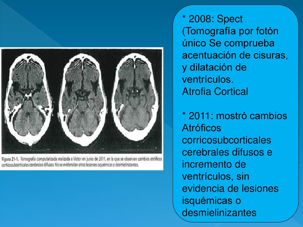* 2008: Spect (Tomografía por fotón único Se comprueba acentuación de cisuras, y dilatación de ventrículos.