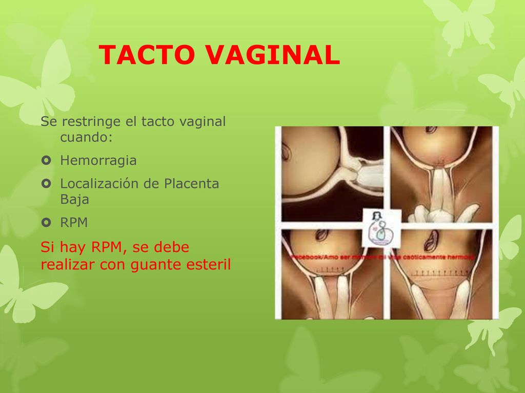 TACTO VAGINAL Si hay RPM, se debe realizar con guante esteril