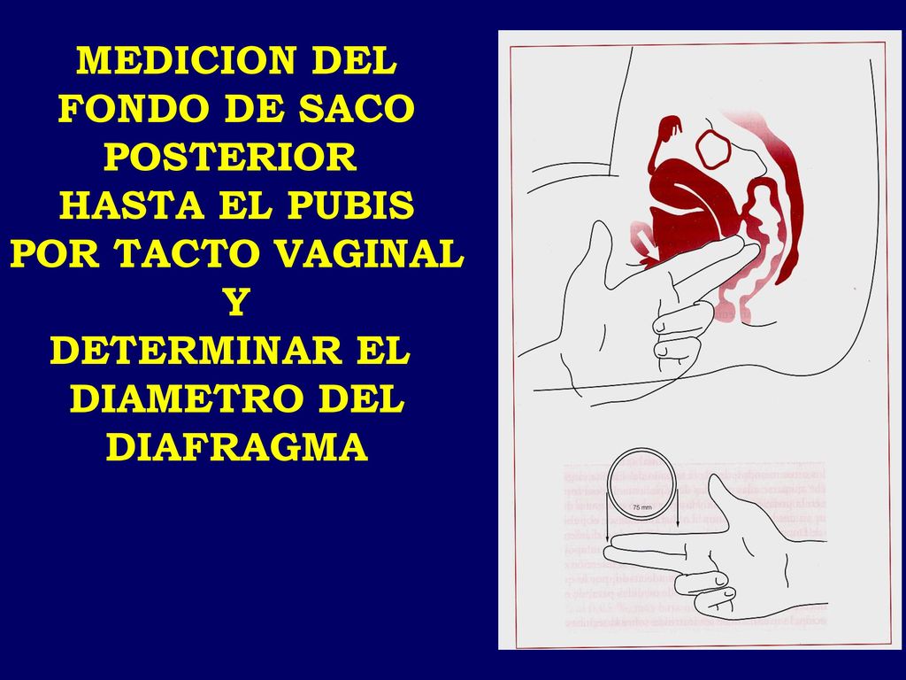 MEDICION DEL FONDO DE SACO. POSTERIOR. HASTA EL PUBIS. POR TACTO VAGINAL. Y. DETERMINAR EL. DIAMETRO DEL.