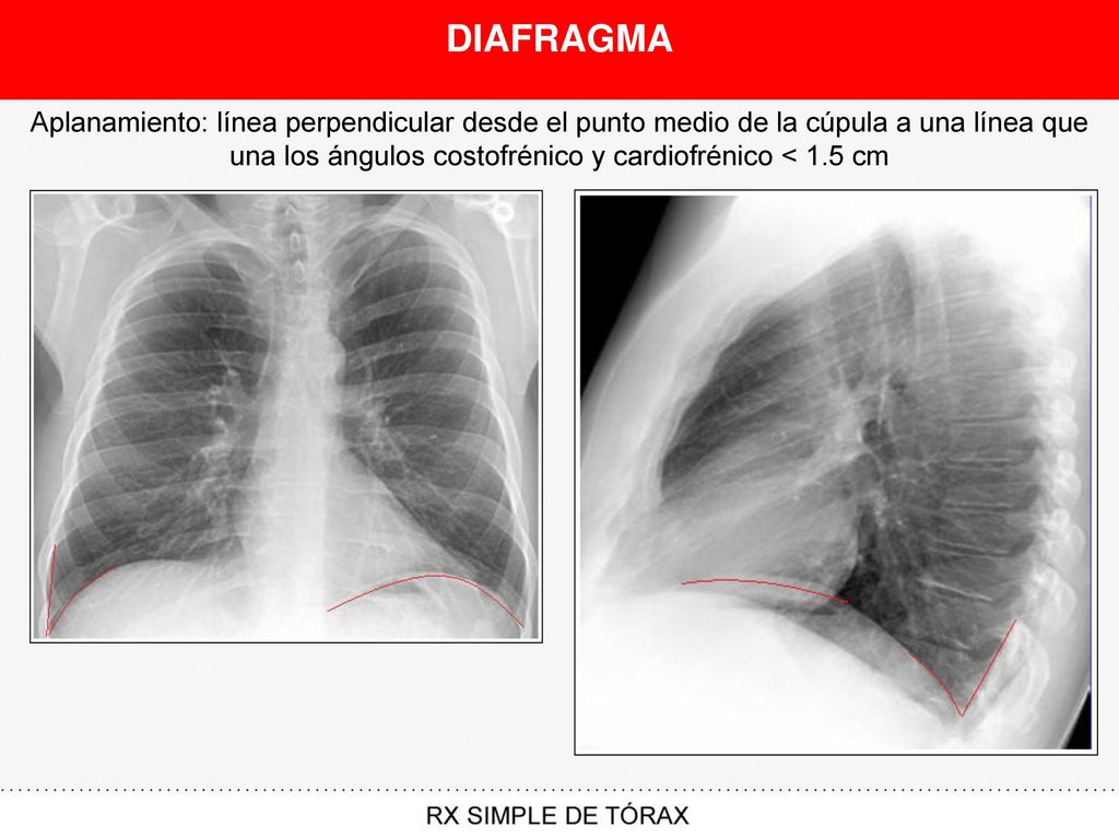 DIAFRAGMA Aplanamiento: línea perpendicular desde el punto medio de la cúpula a una línea que una los ángulos costofrénico y cardiofrénico < 1.5 cm