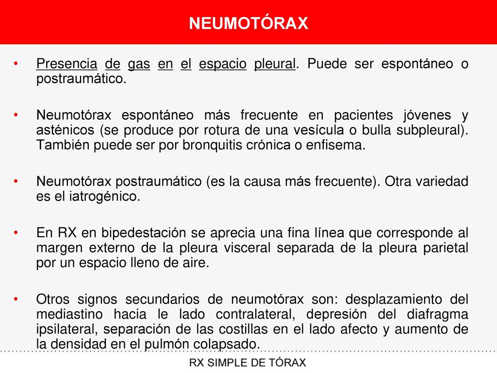 NEUMOTÓRAX Presencia de gas en el espacio pleural. Puede ser espontáneo o postraumático.