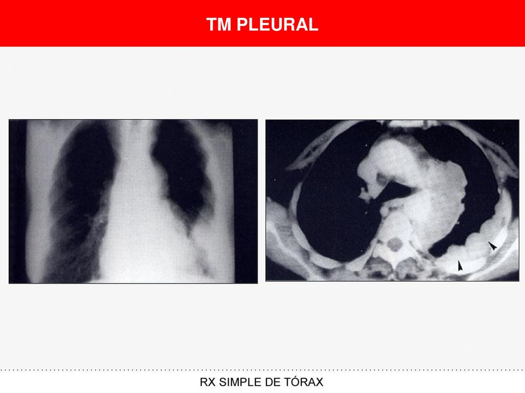 TM PLEURAL
