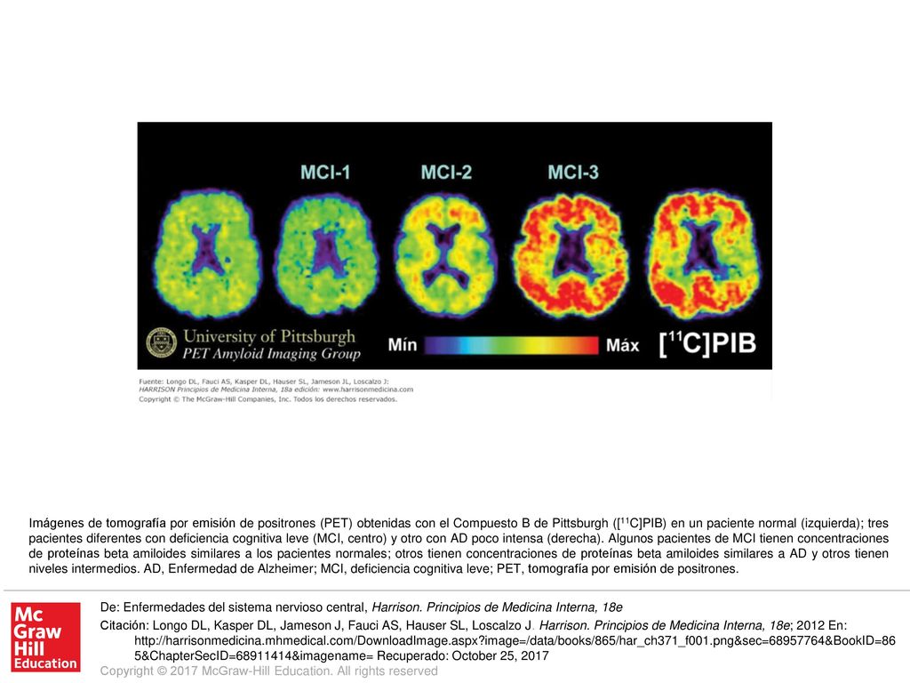 Imágenes de tomografía por emisión de positrones (PET) obtenidas con el Compuesto B de Pittsburgh ([11C]PIB) en un paciente normal (izquierda); tres pacientes diferentes con deficiencia cognitiva leve (MCI, centro) y otro con AD poco intensa (derecha). Algunos pacientes de MCI tienen concentraciones de proteínas beta amiloides similares a los pacientes normales; otros tienen concentraciones de proteínas beta amiloides similares a AD y otros tienen niveles intermedios. AD, Enfermedad de Alzheimer; MCI, deficiencia cognitiva leve; PET, tomografía por emisión de positrones.
