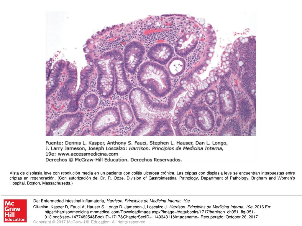 Vista de displasia leve con resolución media en un paciente con colitis ulcerosa crónica. Las criptas con displasia leve se encuentran interpuestas entre criptas en regeneración. (Con autorización del Dr. R. Odze, Division of Gastrointestinal Pathology, Department of Pathology, Brigham and Women’s Hospital, Boston, Massachusetts.)