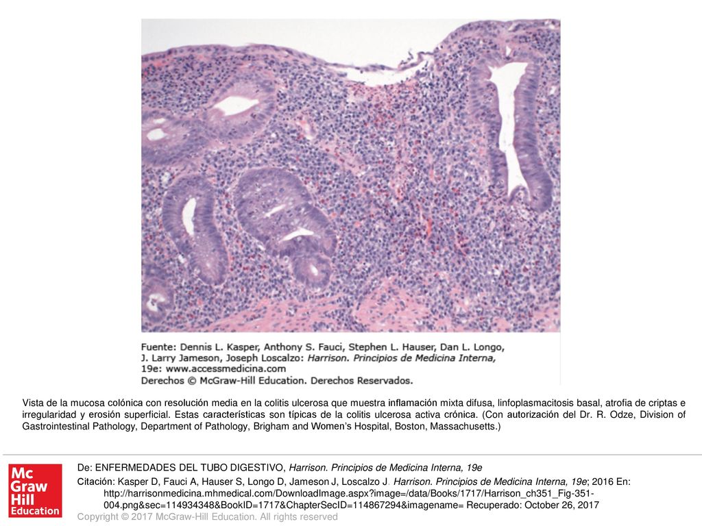 Vista de la mucosa colónica con resolución media en la colitis ulcerosa que muestra inflamación mixta difusa, linfoplasmacitosis basal, atrofia de criptas e irregularidad y erosión superficial. Estas características son típicas de la colitis ulcerosa activa crónica. (Con autorización del Dr. R. Odze, Division of Gastrointestinal Pathology, Department of Pathology, Brigham and Women’s Hospital, Boston, Massachusetts.)