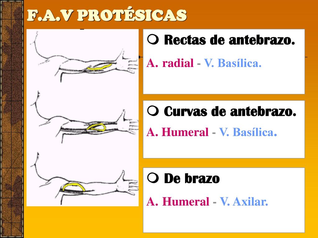F.A.V PROTÉSICAS  Rectas de antebrazo.  Curvas de antebrazo.