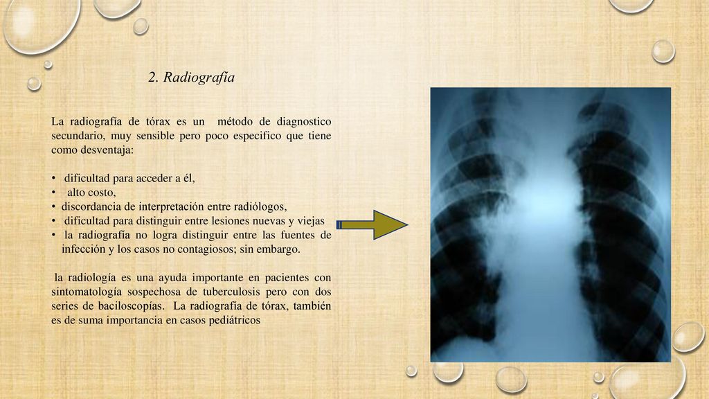 2. Radiografía La radiografía de tórax es un método de diagnostico secundario, muy sensible pero poco especifico que tiene como desventaja:
