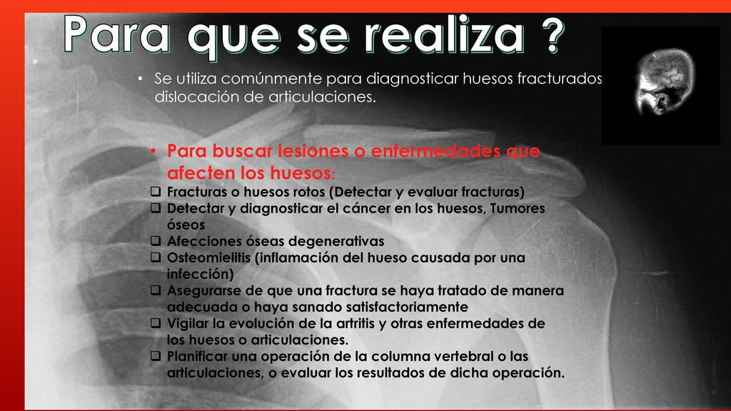 Para que se realiza Se utiliza comúnmente para diagnosticar huesos fracturados o dislocación de articulaciones.