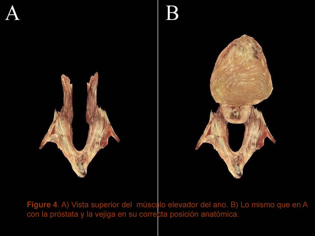 Figure 4. A) Vista superior del músculo elevador del ano