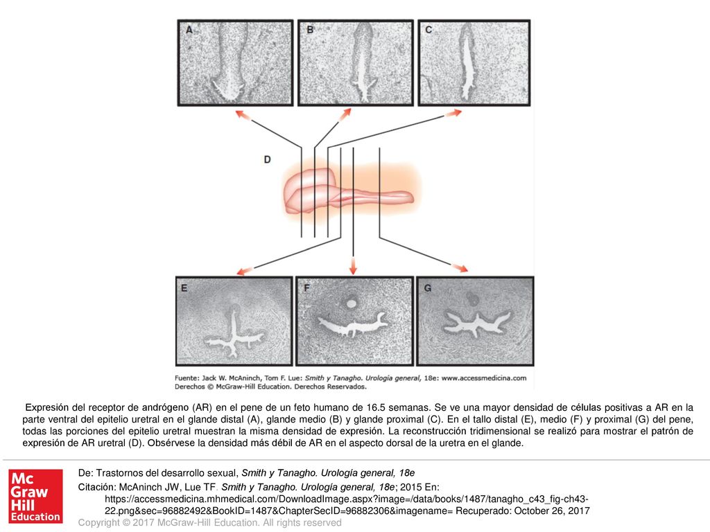 Expresión del receptor de andrógeno (AR) en el pene de un feto humano de 16.5 semanas. Se ve una mayor densidad de células positivas a AR en la parte ventral del epitelio uretral en el glande distal (A), glande medio (B) y glande proximal (C). En el tallo distal (E), medio (F) y proximal (G) del pene, todas las porciones del epitelio uretral muestran la misma densidad de expresión. La reconstrucción tridimensional se realizó para mostrar el patrón de expresión de AR uretral (D). Obsérvese la densidad más débil de AR en el aspecto dorsal de la uretra en el glande.