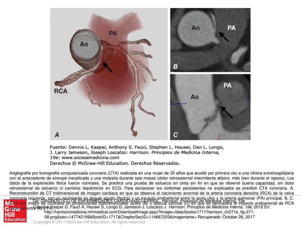 Anglografía por tomografía computarizada coronaria (CTA) realizada en una mujer de 35 años que acudió por primera vez a una clínica extrahospitalaria con el antecedente de síncope inexplicado y una molestia durante seis meses (dolor retroesternal intermitente atípico, más bien durante el reposo). Los datos de la exploración física fueron normales. Se practicó una prueba de esfuerzo en cinta sin fin en que se observó buena capacidad, sin dolor retroesternal de esfuerzo ni cambios isquémicos en ECG. Para esclarecer los síntomas persistentes no explicados se practicó CTA coronaria. A. Reconstrucción de CT tridimensional de imagen cardiaca en que se observa el nacimiento anormal de la arteria coronaria derecha (RCA) de la valva coronaria izquierda, con un nacimiento en ángulo agudo (flecha) y un trayecto endoarterial entre la aorta (Ao) y la arteria pulmonar (PA) principal. B, C. CTA con medio de contraste en proyecciones bidimensionales axiles (B) y oblicua coronal (C) en que se demuestra el trayecto endoarterial de RCA proximal entre Ao y PA.