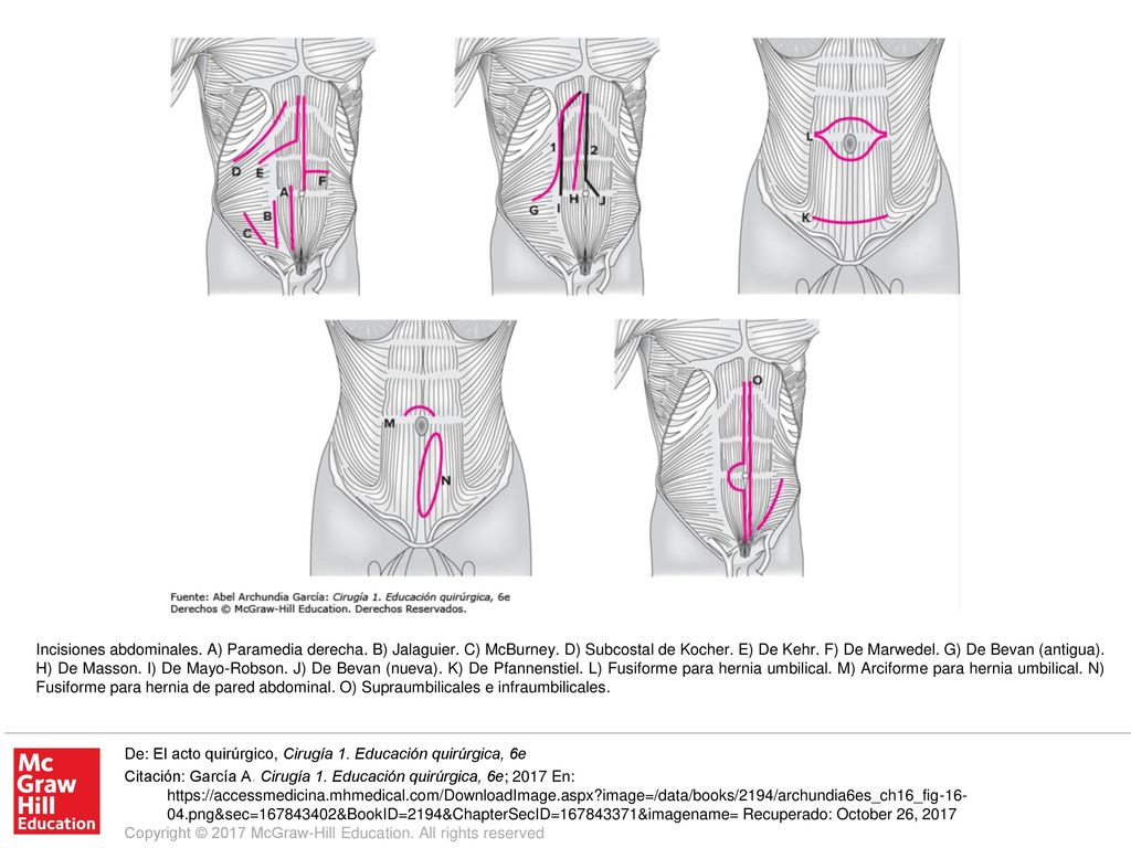 Incisiones abdominales. A) Paramedia derecha. B) Jalaguier. C) McBurney. D) Subcostal de Kocher. E) De Kehr. F) De Marwedel. G) De Bevan (antigua). H) De Masson. I) De Mayo-Robson. J) De Bevan (nueva). K) De Pfannenstiel. L) Fusiforme para hernia umbilical. M) Arciforme para hernia umbilical. N) Fusiforme para hernia de pared abdominal. O) Supraumbilicales e infraumbilicales.