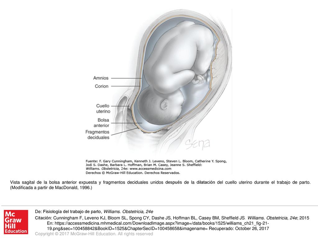 Vista sagital de la bolsa anterior expuesta y fragmentos deciduales unidos después de la dilatación del cuello uterino durante el trabajo de parto. (Modificada a partir de MacDonald, 1996.)