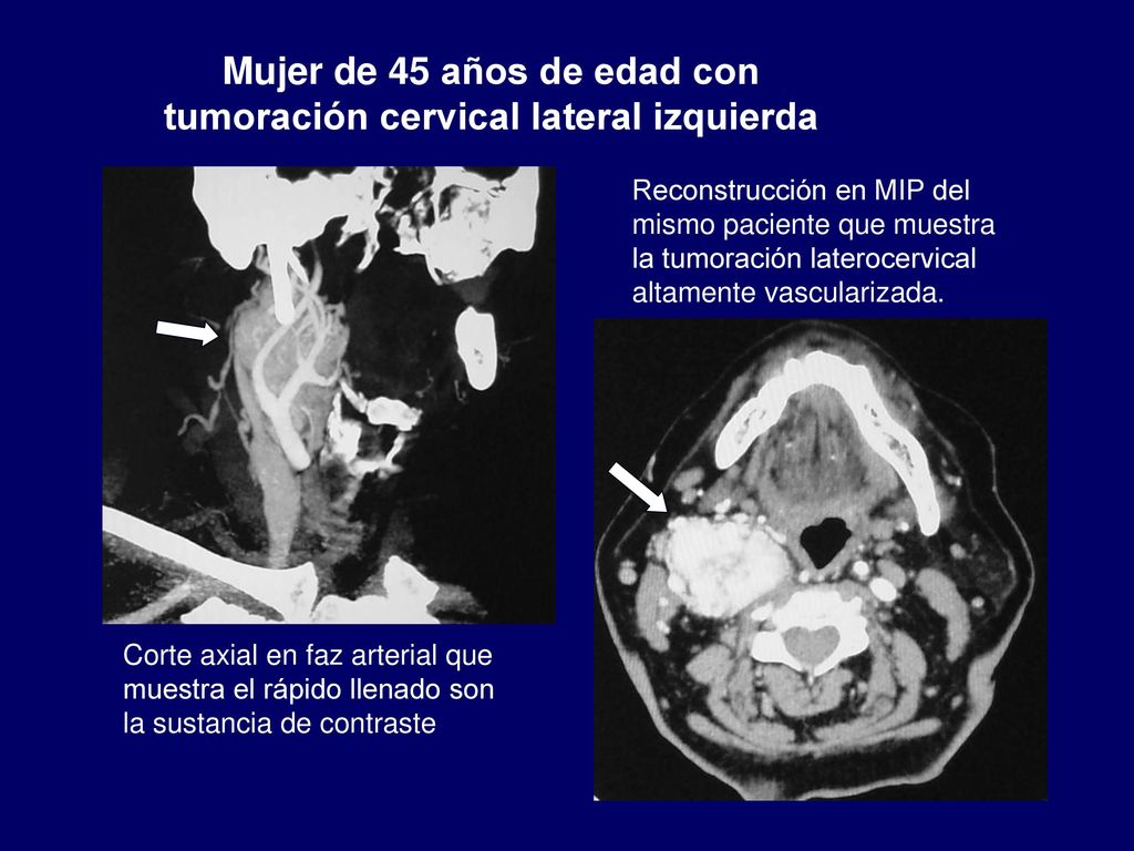 Mujer de 45 años de edad con tumoración cervical lateral izquierda