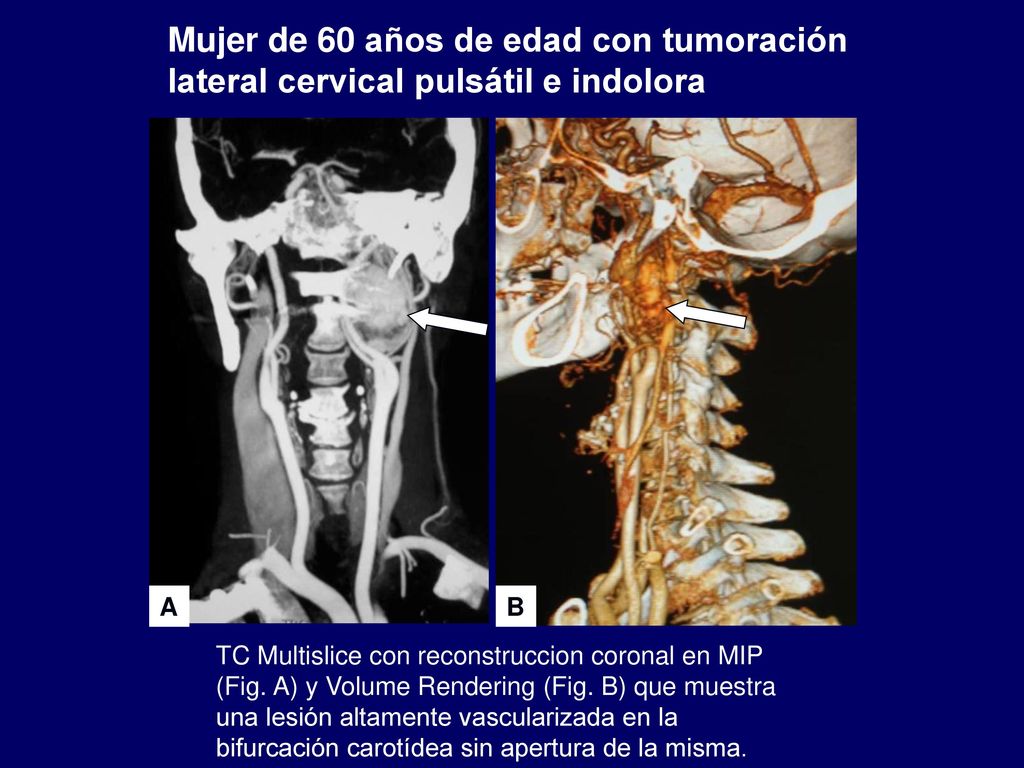 Mujer de 60 años de edad con tumoración lateral cervical pulsátil e indolora