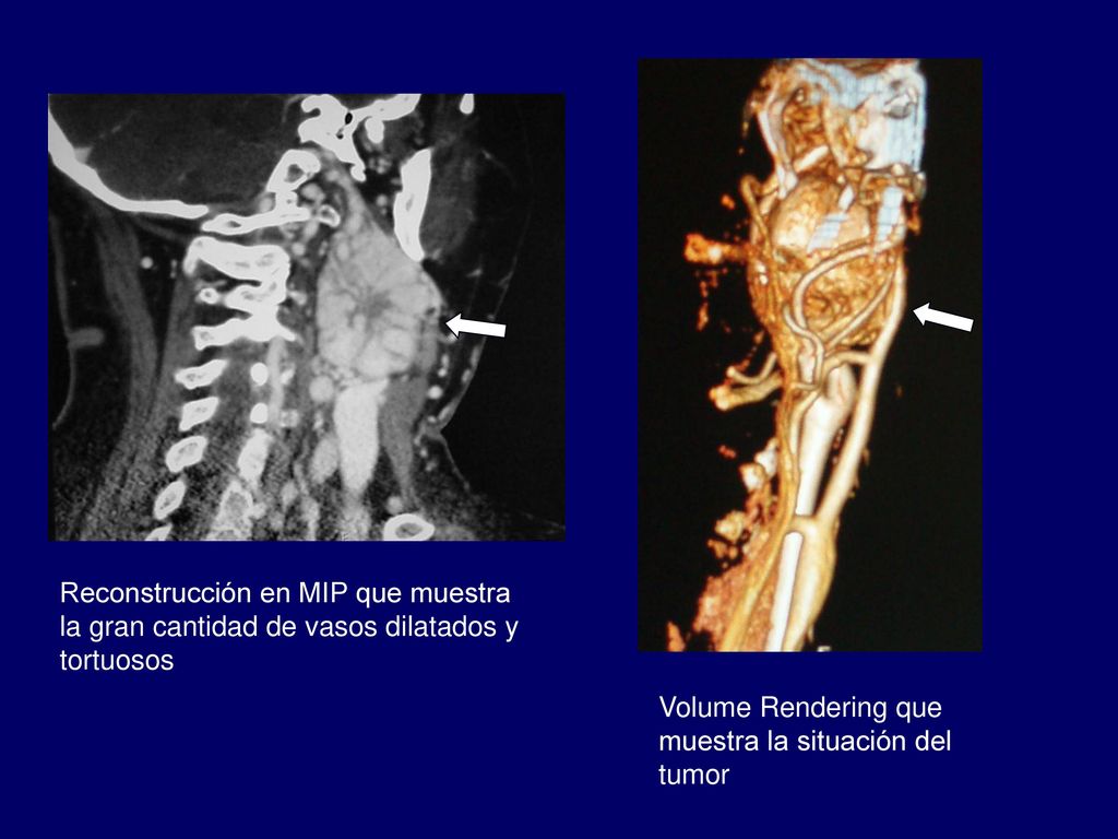 Reconstrucción en MIP que muestra la gran cantidad de vasos dilatados y tortuosos