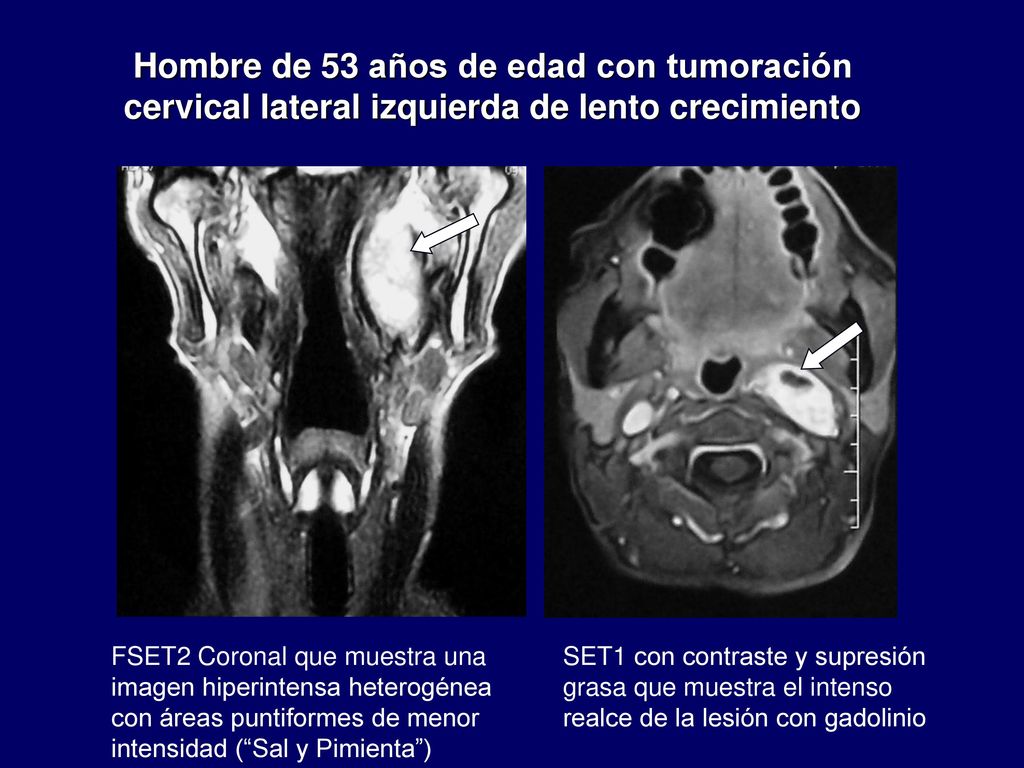 Hombre de 53 años de edad con tumoración cervical lateral izquierda de lento crecimiento