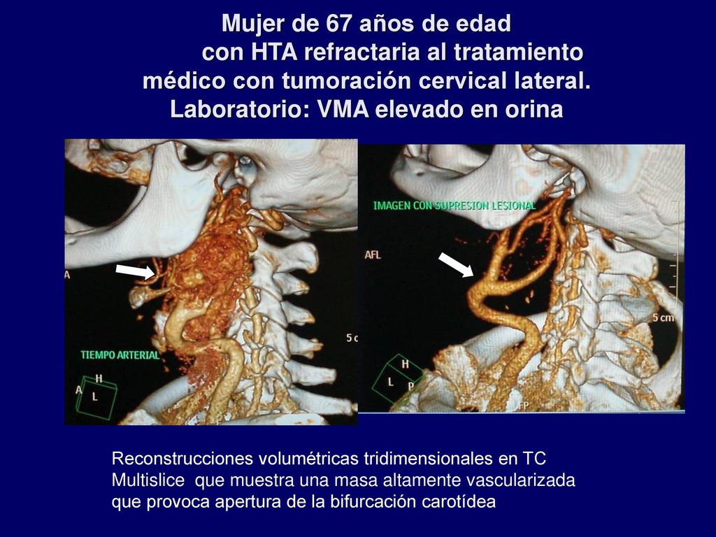 Mujer de 67 años de edad con HTA refractaria al tratamiento médico con tumoración cervical lateral. Laboratorio: VMA elevado en orina