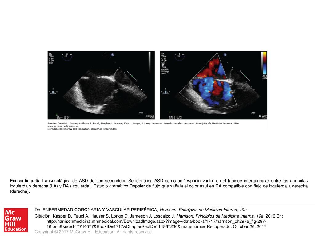 Ecocardiografía transesofágica de ASD de tipo secundum