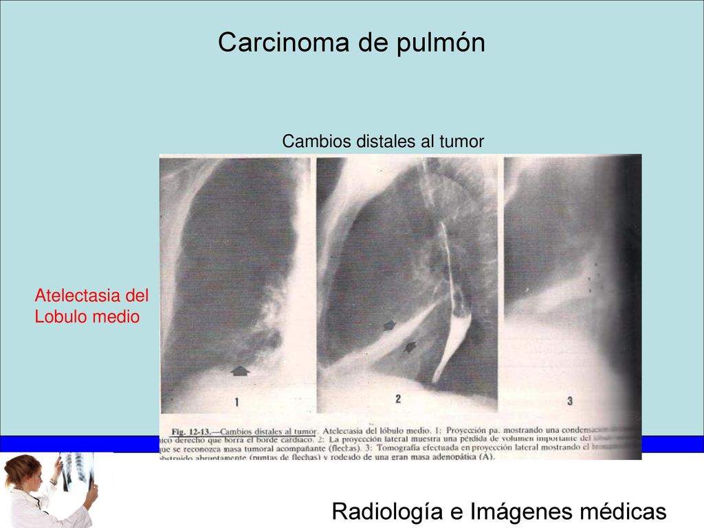 Carcinoma de pulmón Cambios distales al tumor Atelectasia del