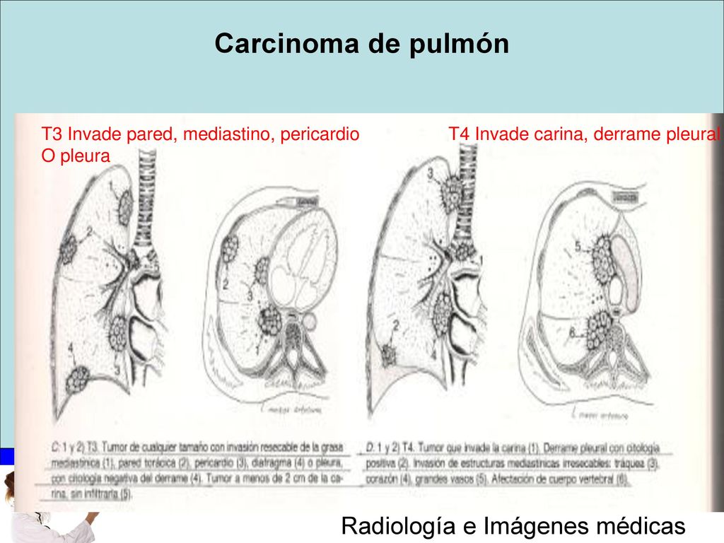 Carcinoma de pulmón T3 Invade pared, mediastino, pericardio O pleura