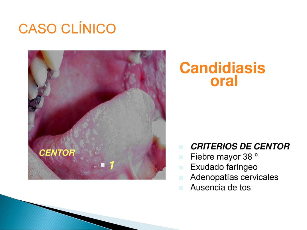 Candidiasis oral CASO CLÍNICO 1 CRITERIOS DE CENTOR Fiebre mayor 38 º