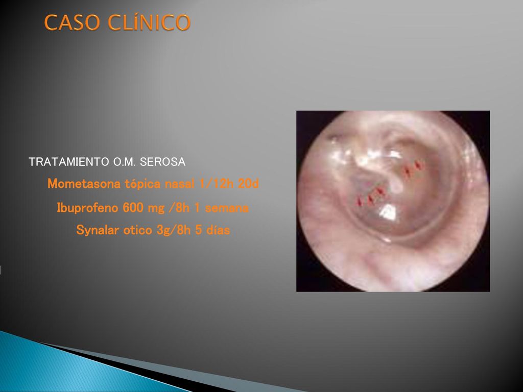 Mometasona tópica nasal 1/12h 20d Ibuprofeno 600 mg /8h 1 semana
