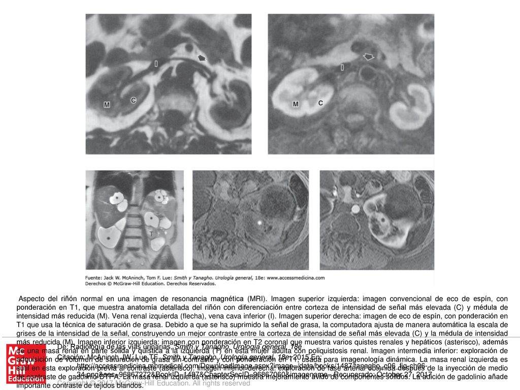 Aspecto del riñón normal en una imagen de resonancia magnética (MRI)
