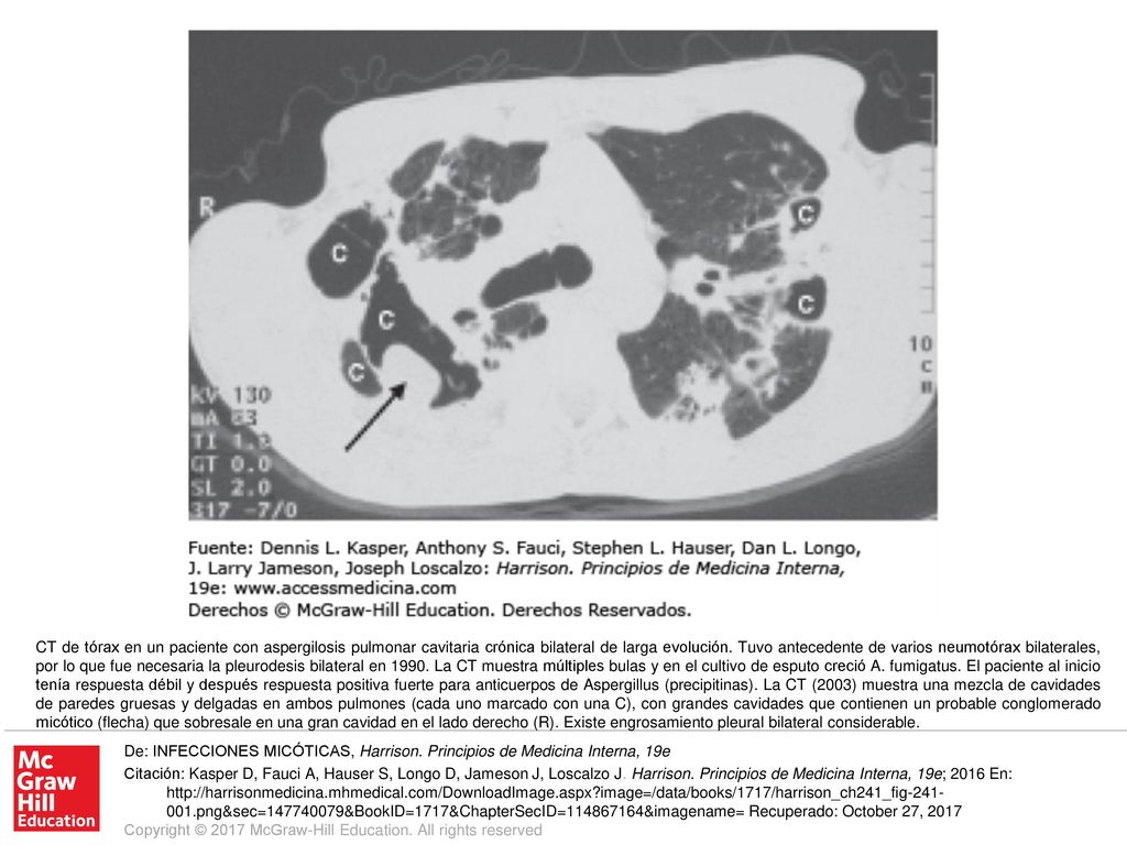 CT de tórax en un paciente con aspergilosis pulmonar cavitaria crónica bilateral de larga evolución. Tuvo antecedente de varios neumotórax bilaterales, por lo que fue necesaria la pleurodesis bilateral en La CT muestra múltiples bulas y en el cultivo de esputo creció A. fumigatus. El paciente al inicio tenía respuesta débil y después respuesta positiva fuerte para anticuerpos de Aspergillus (precipitinas). La CT (2003) muestra una mezcla de cavidades de paredes gruesas y delgadas en ambos pulmones (cada uno marcado con una C), con grandes cavidades que contienen un probable conglomerado micótico (flecha) que sobresale en una gran cavidad en el lado derecho (R). Existe engrosamiento pleural bilateral considerable.