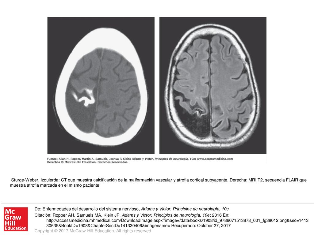 Sturge-Weber. Izquierda: CT que muestra calcificación de la malformación vascular y atrofia cortical subyacente. Derecha: MRI T2, secuencia FLAIR que muestra atrofia marcada en el mismo paciente.