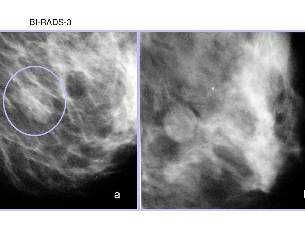 Категории маммографии. Маммография bi-rads 4. Маммография молочных желез bi rads 4. Фиброзно кистозная мастопатия молочной железы bi-rads-4a. Bi-rads 3 молочной железы маммограмма.