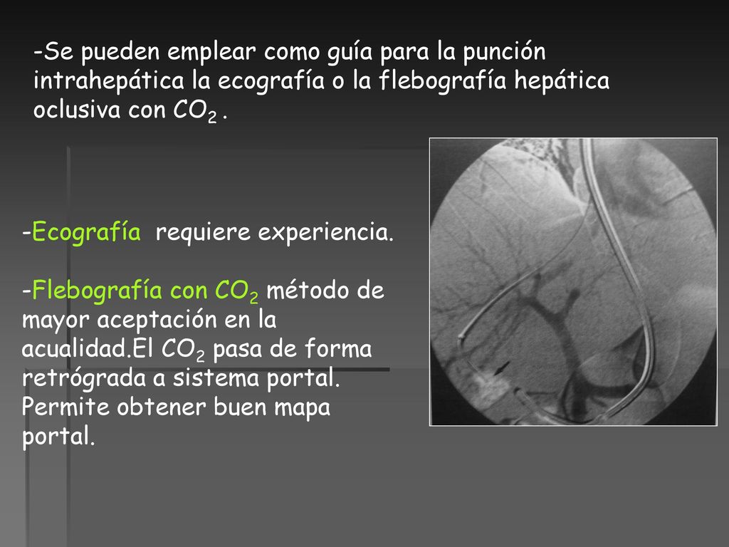 -Se pueden emplear como guía para la punción intrahepática la ecografía o la flebografía hepática oclusiva con CO2 .